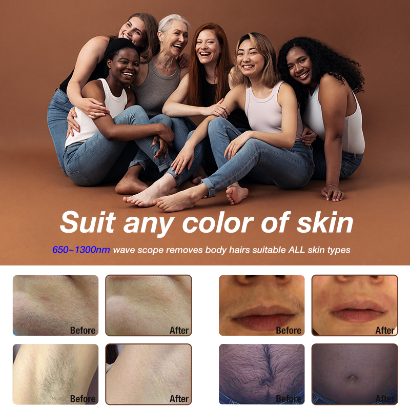 Winkonlaser® VL10 LED Hair Removal Machine 650nm~1300nm Waves Suitable All Skin Types