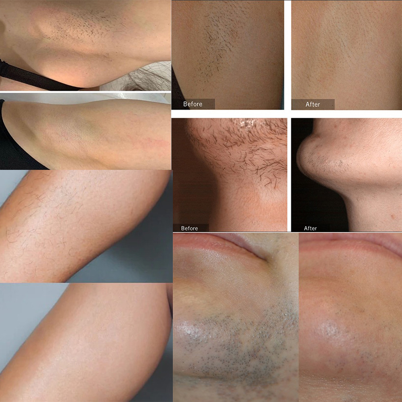 Winkonlaser® VL10 LED Hair Removal Machine 650nm~1300nm Waves Suitable All Skin Types